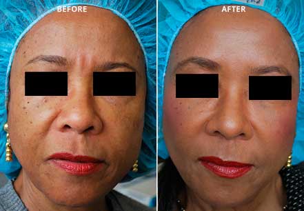 Photo of the patient’s face before and after non-surgical Radiesse dermal filler treatment. Patient 1 - Set 1