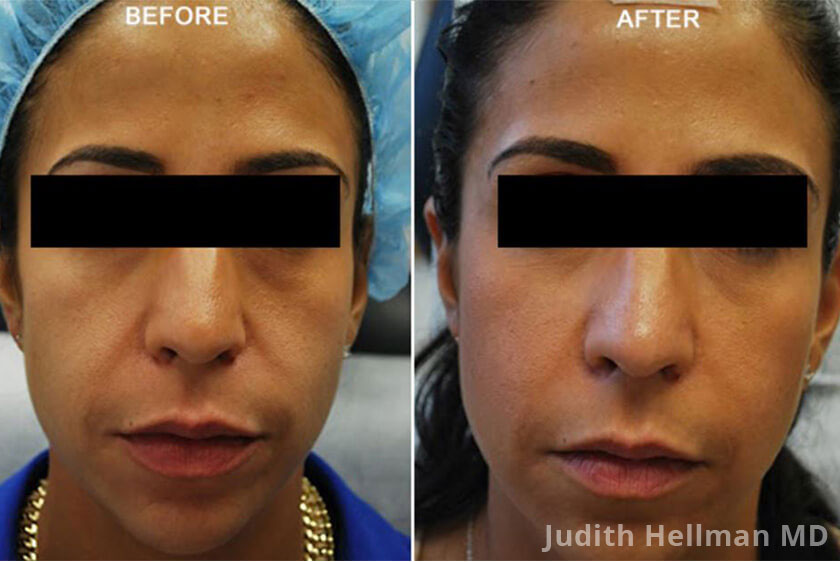 Photo of the patient’s face before and after Restylane & Perlane treatment. Patient 5 - Set 2