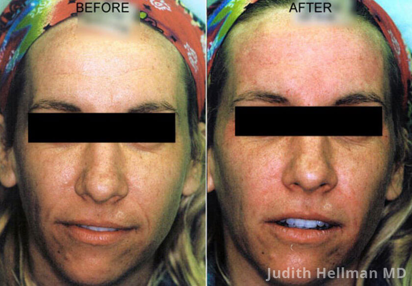 Photo of the patient’s face before and after Restylane & Perlane treatment. Patient 12 - Set 1