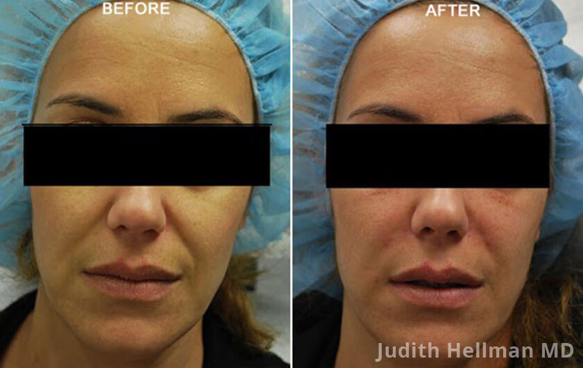 Photo of the patient’s face before and after Restylane & Perlane treatment. Patient 13 - Set 1