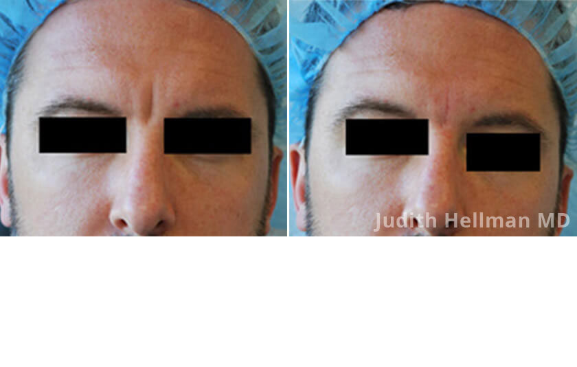 Photo of the patient’s face before and after Restylane & Perlane treatment. Patient 16 - Set 1