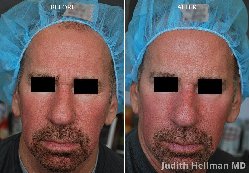 Photo of the patient’s face before and after Restylane & Perlane treatment. Patient 2 - Set 1