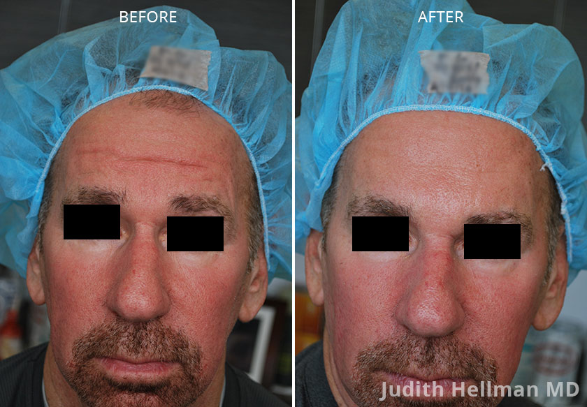 Photo of the patient’s face before and after Restylane & Perlane treatment. Patient 2 - Set 2