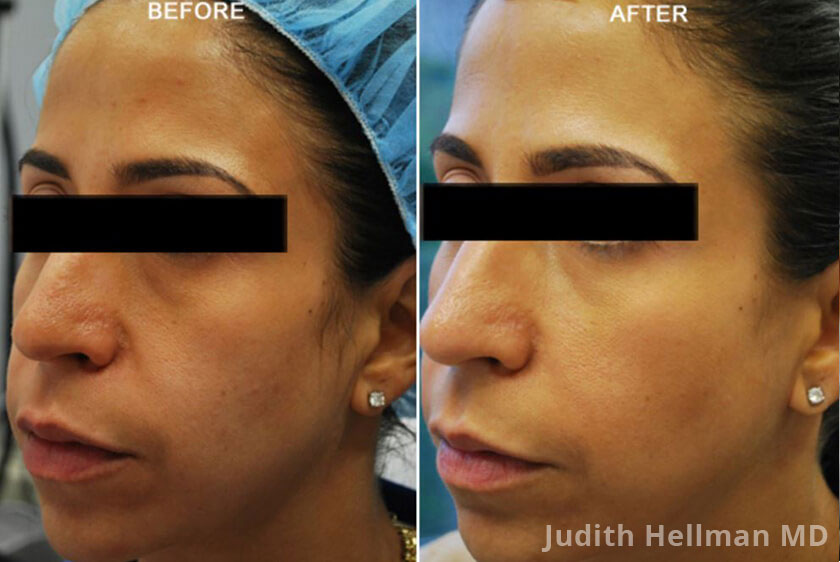 Photo of the patient’s face before and after Restylane & Perlane treatment. Patient 5 - Set 1