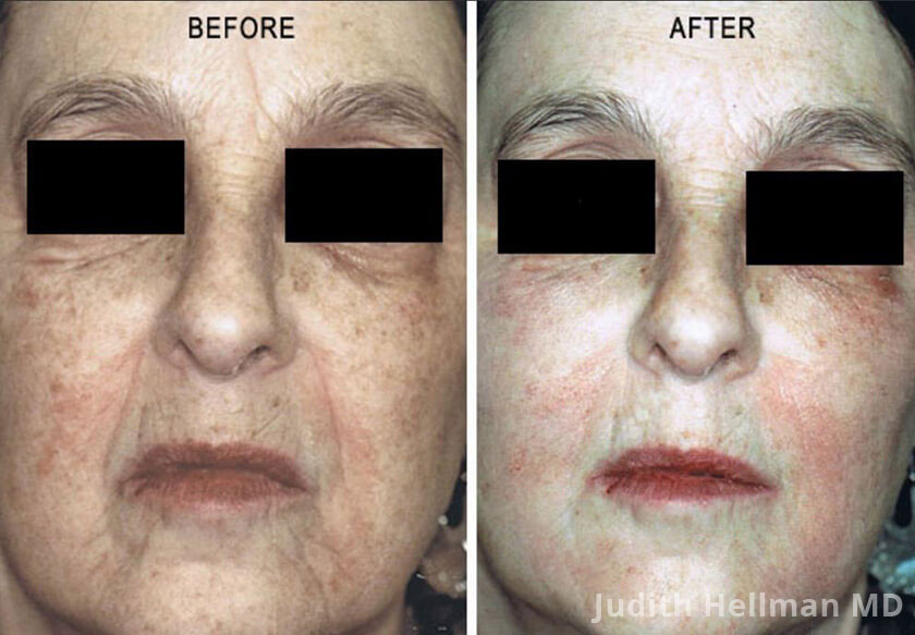 Photo of the patient’s face before and after Restylane & Perlane treatment. Patient 4 - Set 1
