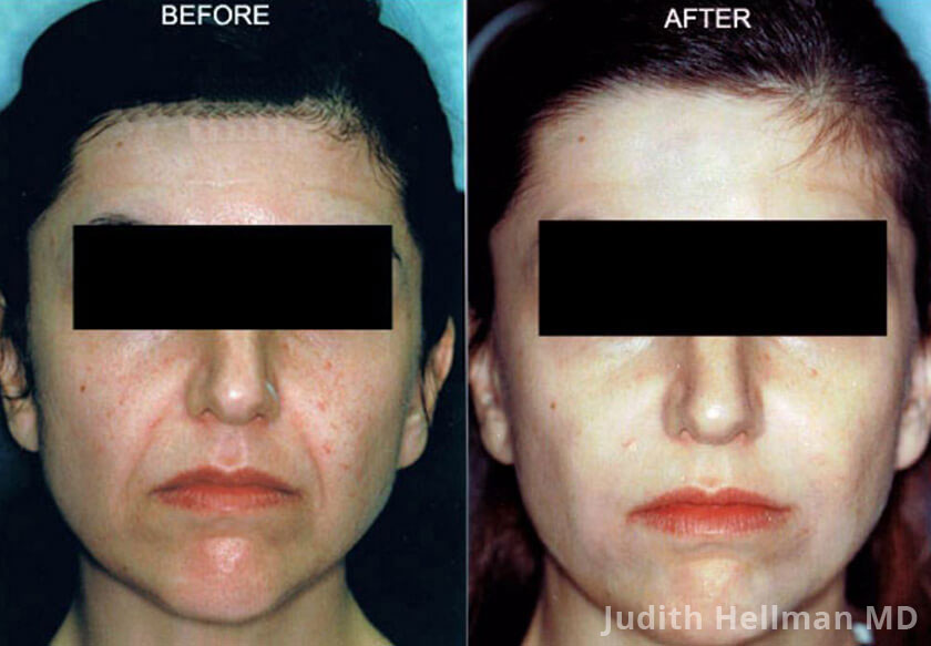 Photo of the patient’s face before and after Restylane & Perlane treatment. Patient 6 - Set 1