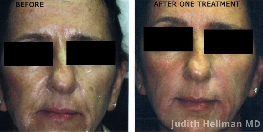 Photo of the patient’s face before and after Restylane & Perlane treatment. Patient 7 - Set 1