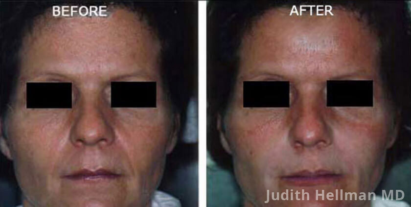 Photo of the patient’s face before and after Restylane & Perlane treatment. Patient 8 - Set 1