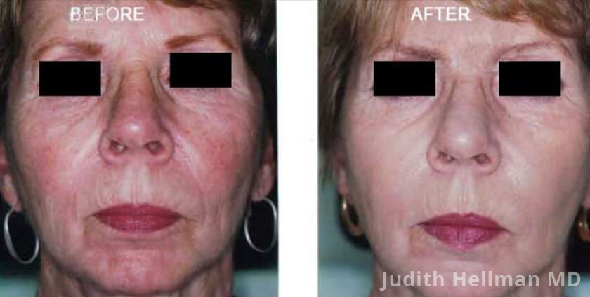 Photo of the patient’s face before and after Restylane & Perlane treatment. Patient 9 - Set 1