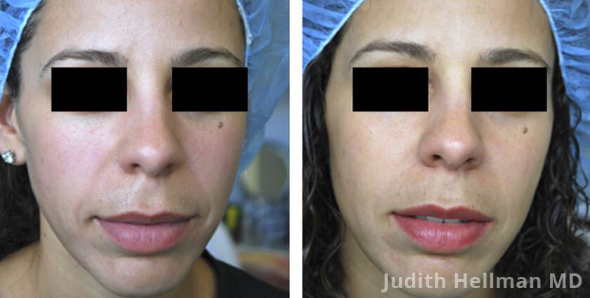 Photo of the patient’s face before and after Restylane & Perlane treatment. Patient 10 - Set 1