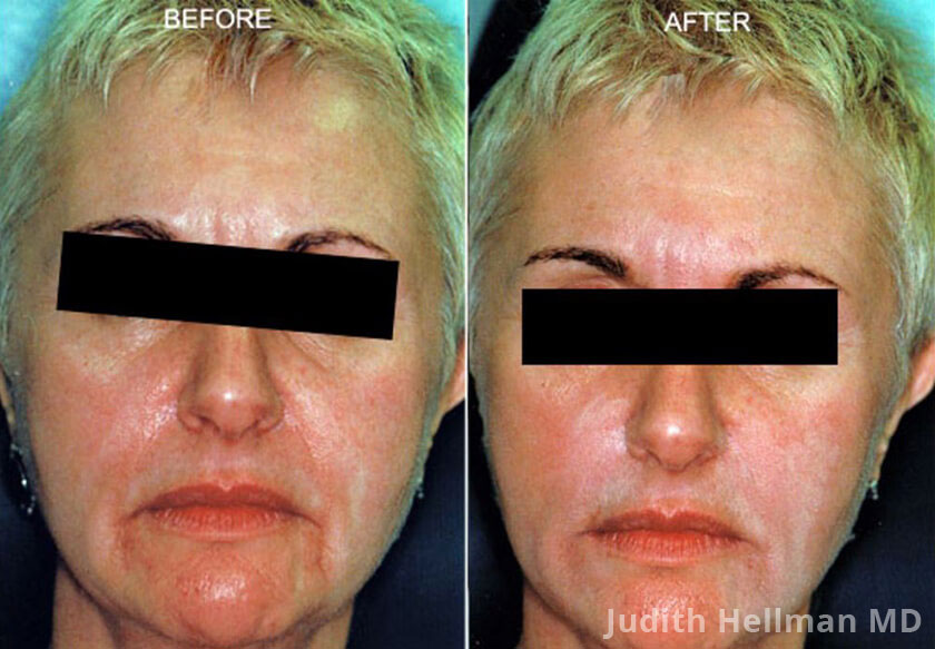 Photo of the patient’s face before and after Restylane & Perlane treatment. Patient 11 - Set 1