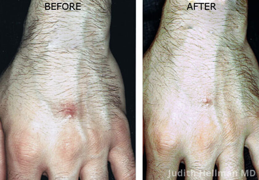 Male hand, before and after treatment of raised scar, front view, patient 2