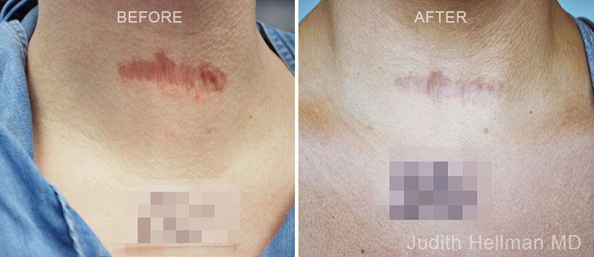 Patient neck, before and after treatment scar removal, front view, patient 1