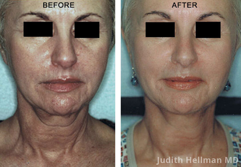 Female face, before and after skin tightening treatment. Face, neck - front view, patient 1