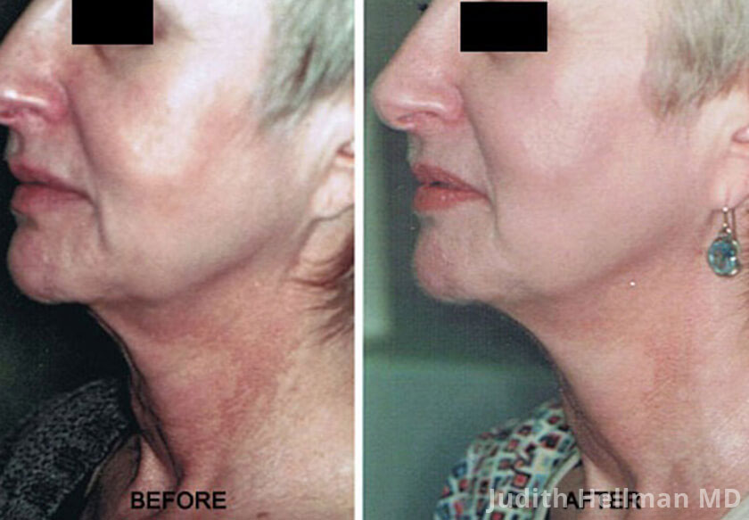 Laser Skin Tightening Before And After