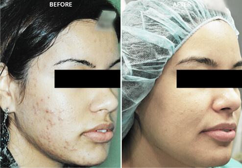 Woman's face, before and after Morpheus 8 and Fractora treatment, oblique view
