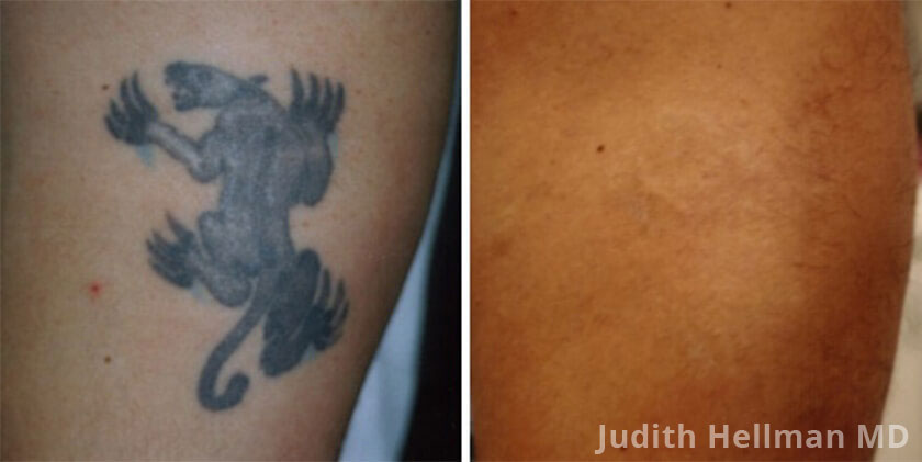 Tattoo Removal Home Remedies Natural  Permanent  9jafoods