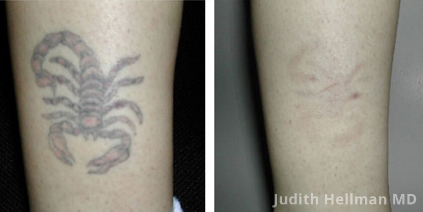 Tattoo Removal With The Naturalase Qs - Before and After photos - patient 2