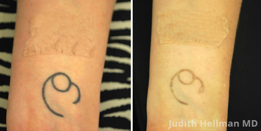 Tattoo Removal Before  After Photos NYC