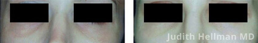 Patient face, before and after under eye bag and dark circle treatment . Under eyes dark circle, front view - patient 1