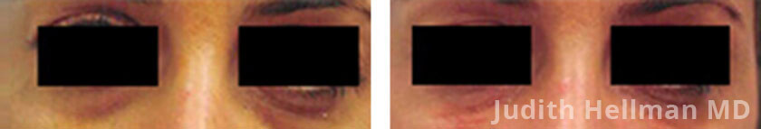 Woman's face, before and after under eye bag and dark circle treatment . Under eyes dark circle, front view - patient 2