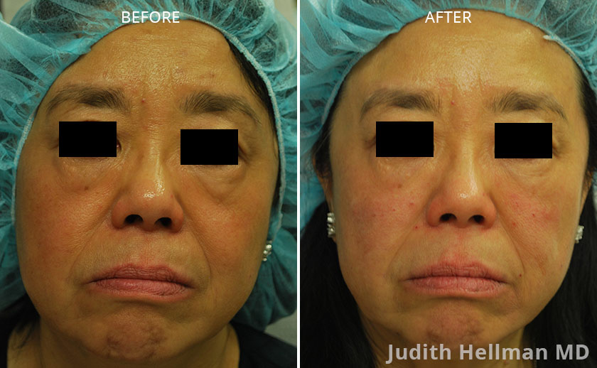 Woman's face, before and after under eye bag and dark circle treatment . Under eyes dark circle, front view - patient 3