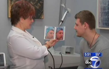 Watch Video: Dr. Hellman featured on ABC News discussing laser acne treatment Fractora